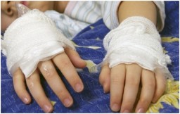 В н.п. Сорокино и Родаково дети 3-х и 5-ти лет получили серьезные ожоги